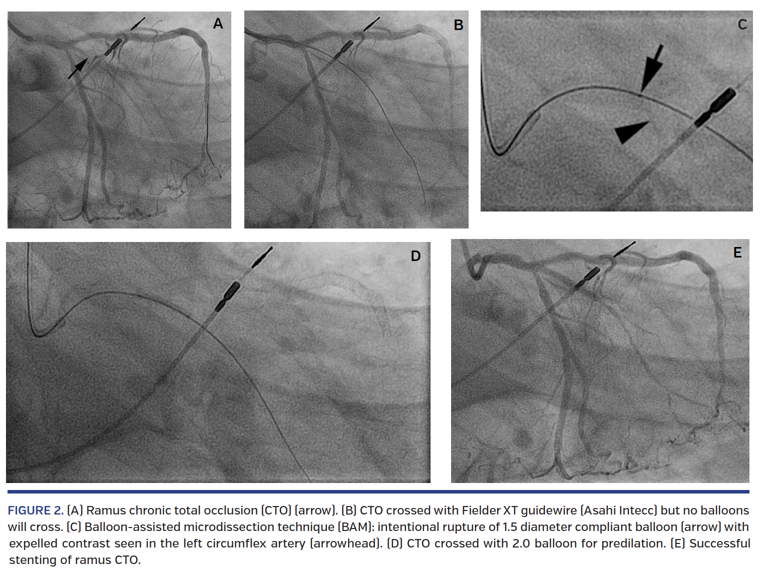 ENCYCLOPAEDIA of OCCLUSION【裁断済】 Stenting Techniques in Left Main Bifurcation Disease | JIC